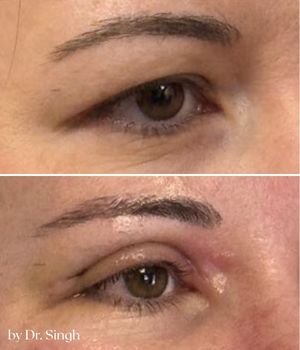 before after blepharoplasty nyc